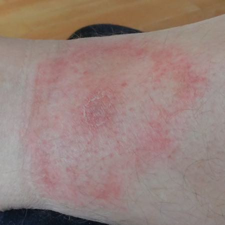 Tick bite after 4 weeks just before antibiotics treatment